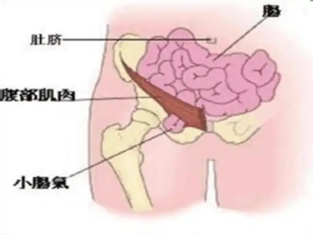 扩散孩子哭闹后大腿根鼓个包居然是