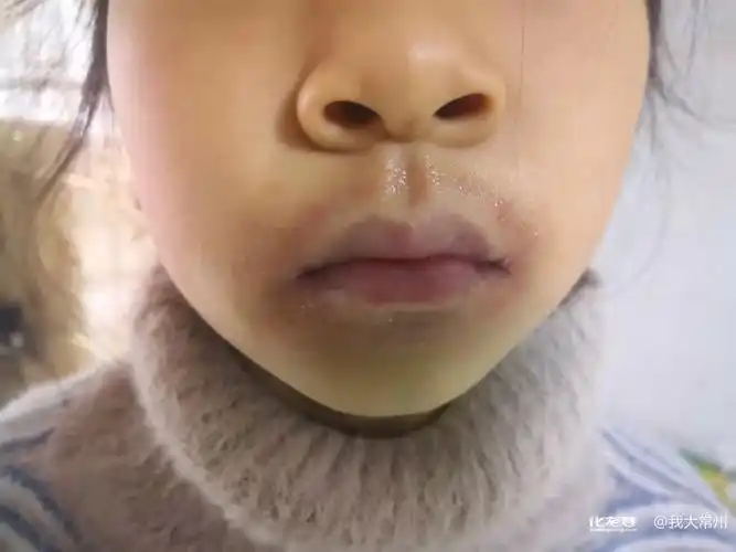 请问各位巷友们,孩子得了唇炎,有什么办法吗?