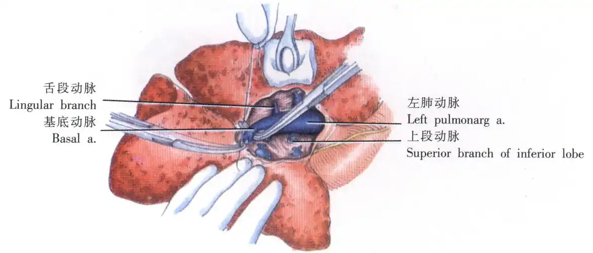 左肺下叶切除术过程图-手术图解 适应症:周围性肺癌,局限于肺叶内的不