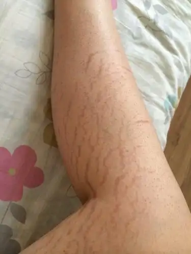 腿上有类似妊辰纹一样的纹,很难看穿不了裙子,有什么办法去掉