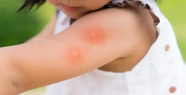 买一赠一的蚊子包 来源丨inside