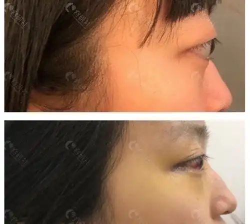 眼睛近视会导致眼球突出吗?中韩做突眼矫正好的医生有哪些?