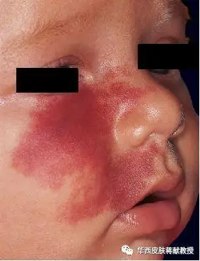 四川大学华西医院皮肤性病科成功举办"红胎记"宣讲会