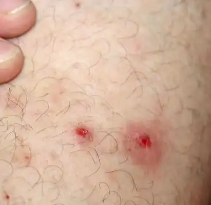 火疖子各时期图片45