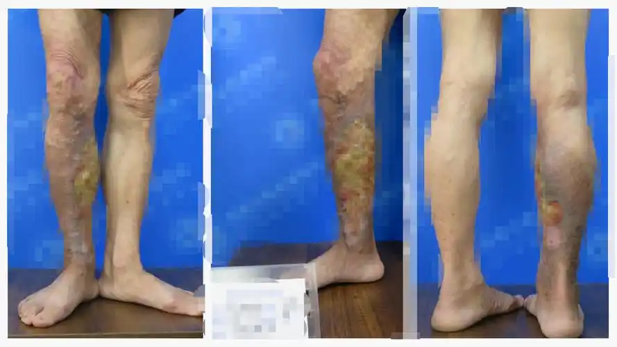 冬季要预防曲张静脉破裂出血