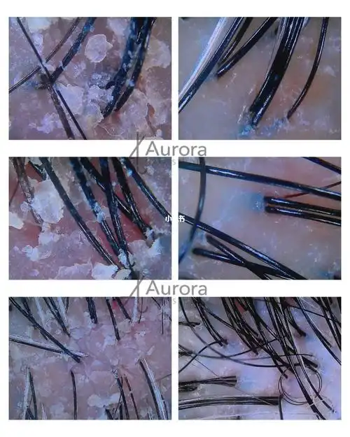 7215有健康的头皮才能拥有健康的秀发72157215护理前后