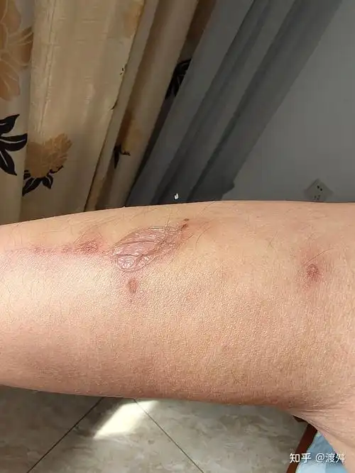 浅二度烫伤的恢复历程 - 知乎