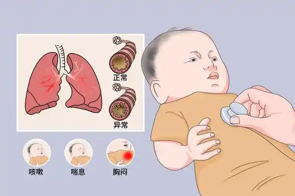 咳咳咳,孩子咳嗽老不好,小心是支气管哮喘!