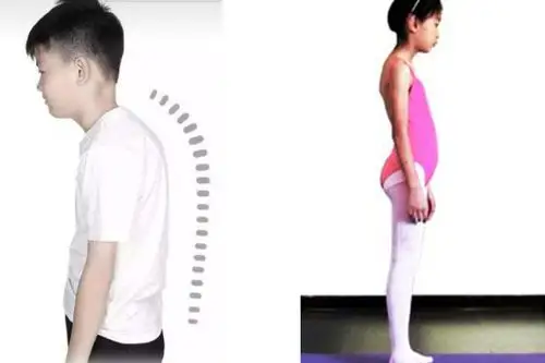 儿童最常见的两种体态问题解析 内因找到了,让孩子"挺直"做人