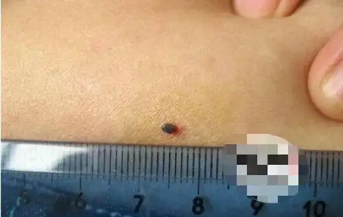 住宾馆被虫咬伤女子来京旅游吓出冷汗图