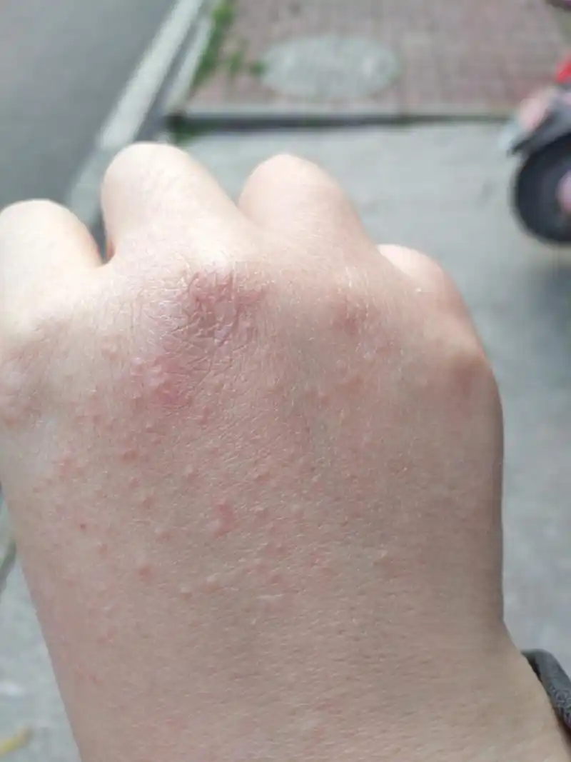 手背上起了些小疙瘩,是什么 最近发现长多了,今天早上醒来有点痒,其他
