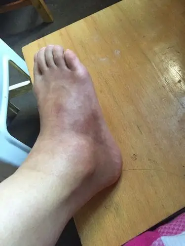 问:我的脚崴了一个半月了,现在走路还是不太行,走路还会肿,扭动脚踝处