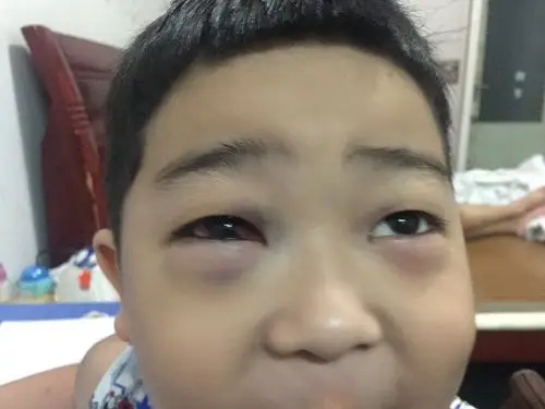 咳嗽憋气把血管压破了?