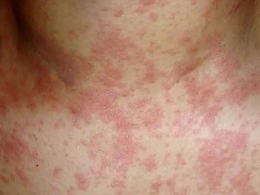 艾滋初期皮疹图片40
