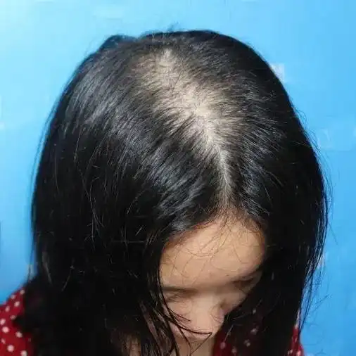 图1图2图3图4属于典型的脂溢性脱发,表现为女性头顶发缝向两 - 抖音