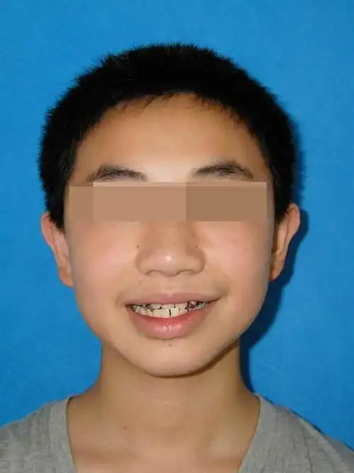 小孩地包天牵引器