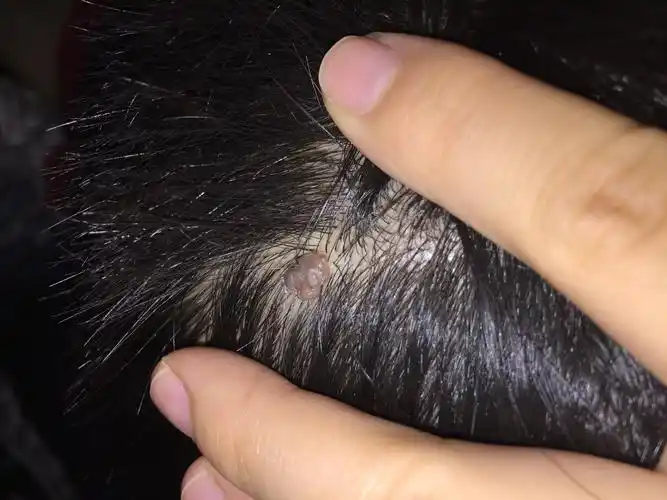 这个不知道长了多少年了有人说是痣摸着软呼呼的不清楚能