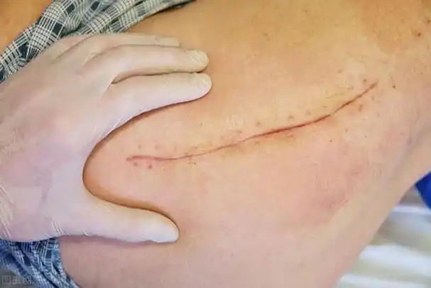 乳腺癌全切后的手术疤痕能不能淡化? - 石塘网