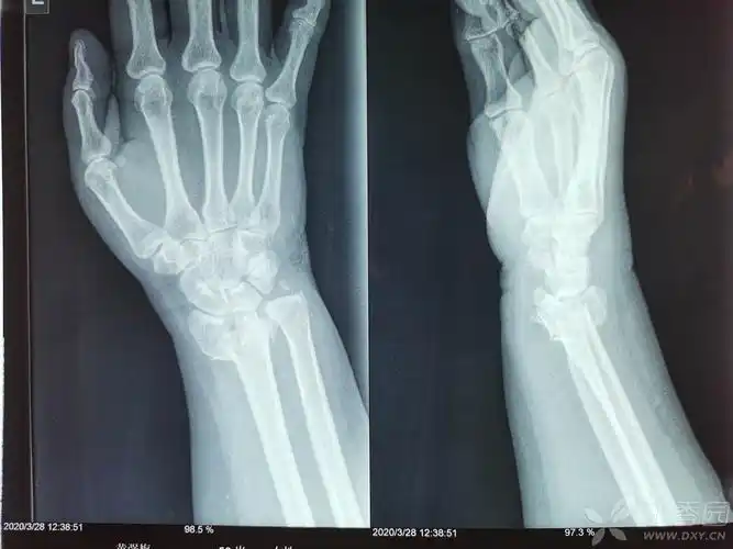 一例桡骨远端粉碎性骨折 复位前和复位后