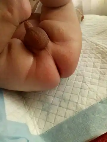 可恶的尿布疹_宝宝树