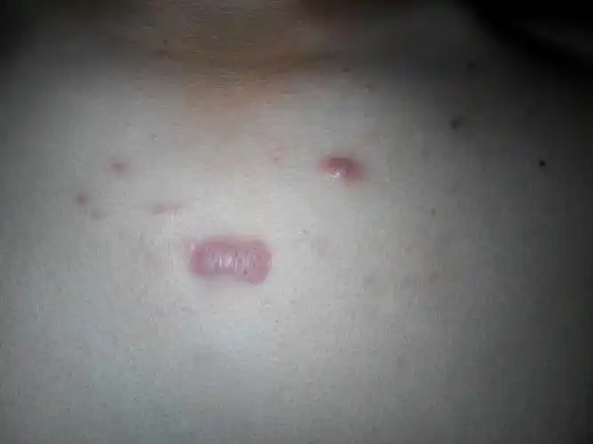 我的胸前有两个痘痘颜色是深红色的不疼也不痒感觉是个疙瘩但也不