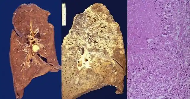 干酪样坏死(肺结核)