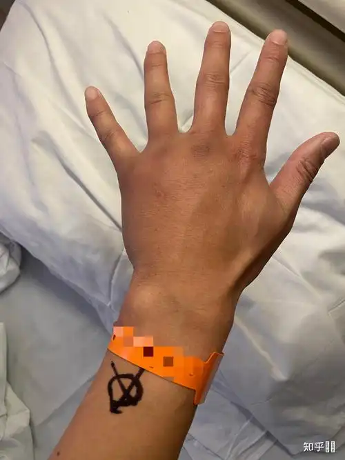 右手第四掌骨骨折保守治疗的第16天,恢复的是否不太理想? - 知乎