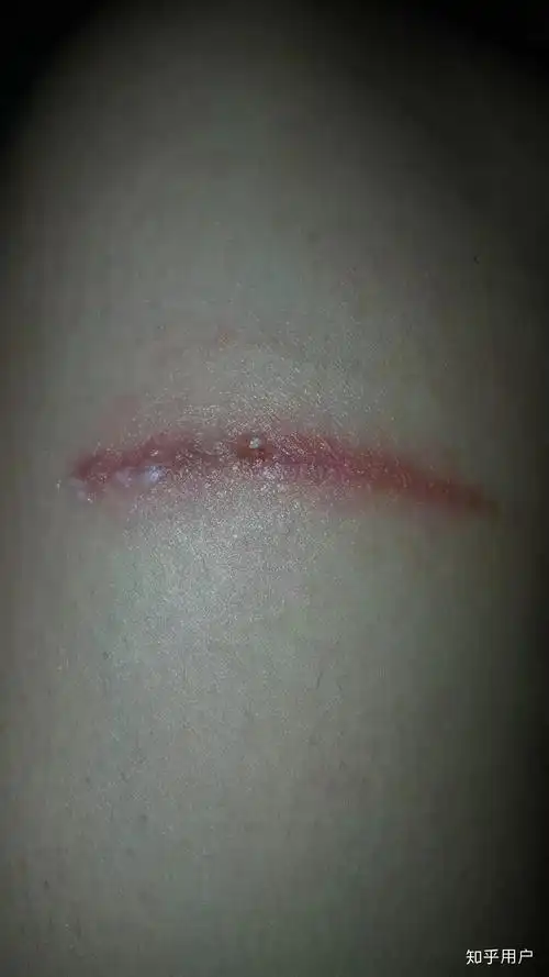 隐翅虫造成的伤口有什么特点