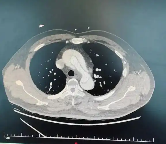 胸背疼痛务必及时就医警惕凶险的主动脉夹层