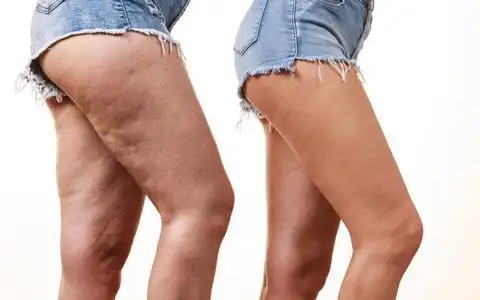 身体松弛对比女性双腿大腿和无脂肪的比较.