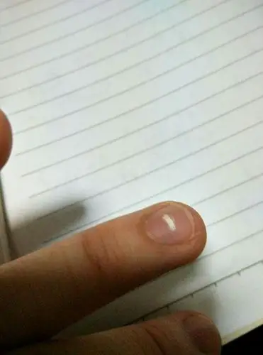 手指出现这白斑是什么情况?