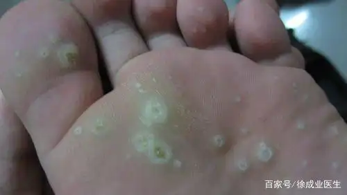 "刺瘊","瘊子","鱼休子"?这都是什么?该拿你们怎么办?