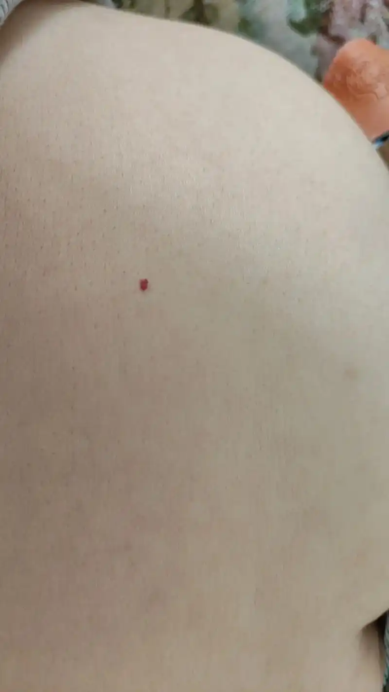 去年开始身上长了好多这个红点点,还有在长的,有的说是血管瘤