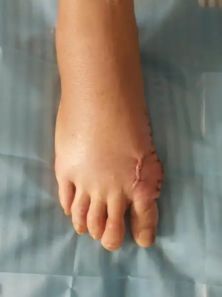 勐海县中医医院成功开展拇外翻截骨矫形手术