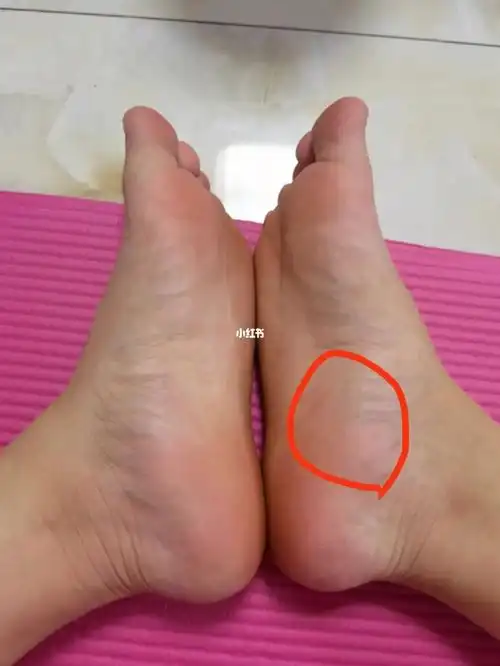 做运动的时候脚掌这块肉疼而且很硬