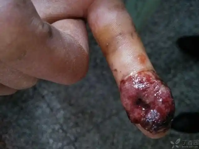 【病例讨论】手指挤压伤