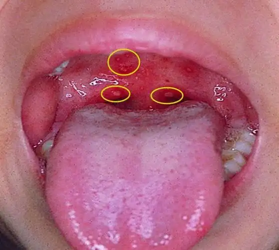 额尔古纳市民族幼儿园传染病知识宣传————手足口病