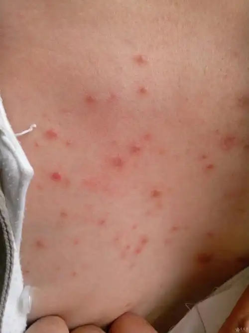 还有一例胸前丘疹的 - 皮肤及性传播疾病讨论版 - 爱爱医医学论坛