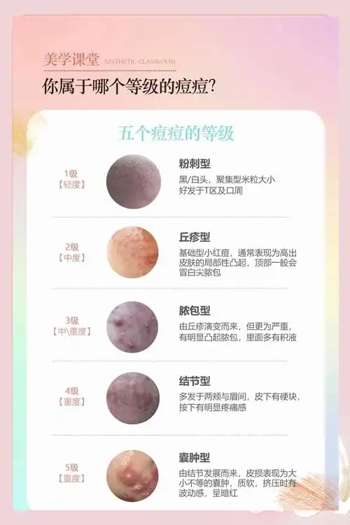 粉刺型 表现为黑头或白头,米粒大小,常出现在t区和口周