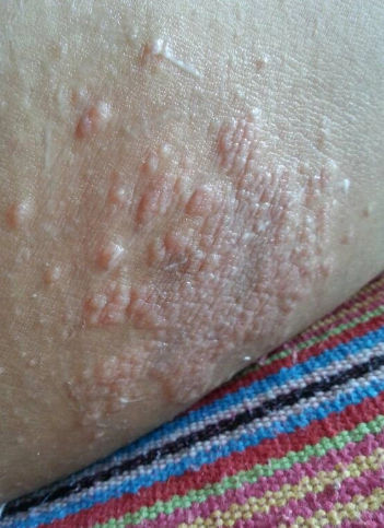 体癣图片_体癣症状表现图片大全_有来医生