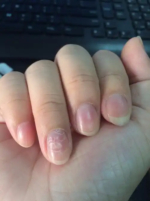 右手无名指指甲坑坑洼洼是怎么回事