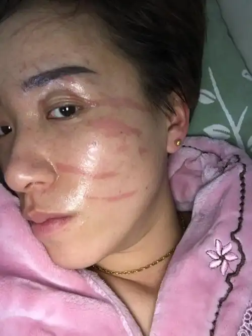 脸上被抓伤结痂脱落后有很明显的红印子,会不会留疤痕呀?