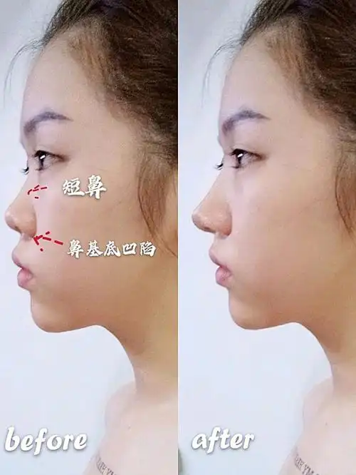 鼻子山根低平,鼻梁塌,鼻翼宽,鼻基底凹陷,鼻头圆钝,鼻小柱内