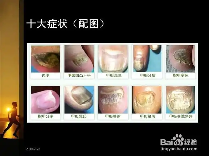 灰指甲的症状有哪些