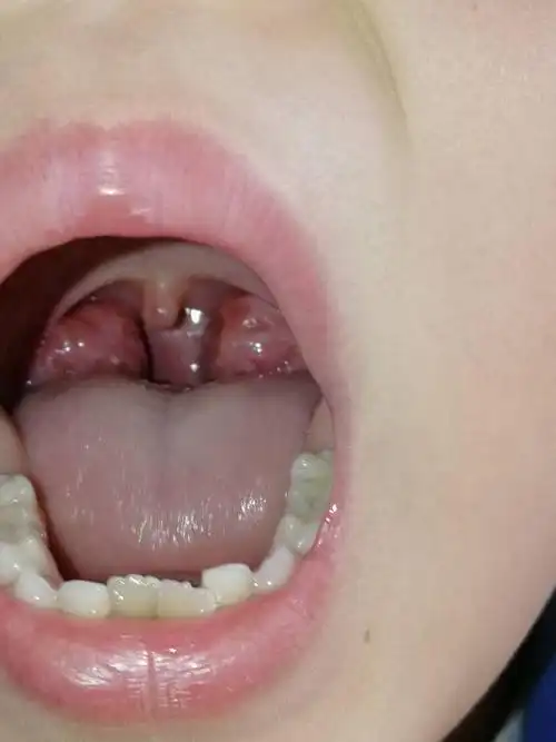 孩子六周岁 最近一直嗓子不舒服嗯嗯的 大夫说扁桃体