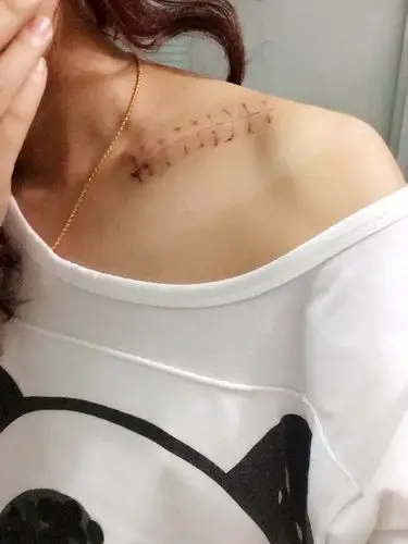 2014-02-28 蒋群礼 医师 我双肩锁骨骨折动了手术20天了,伤口不痛