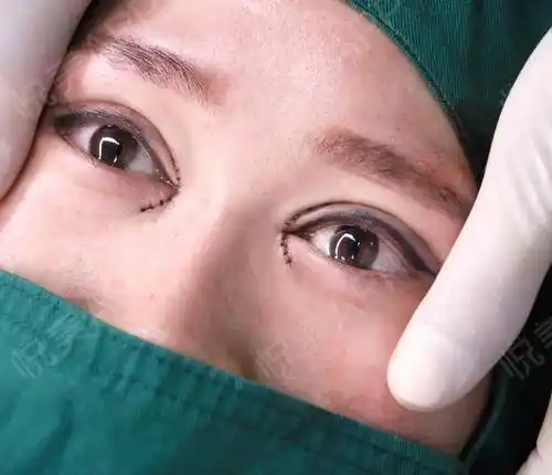 大家好我今天做了脂肪填充眼综合的手术其实也都是微整啦但是变化却
