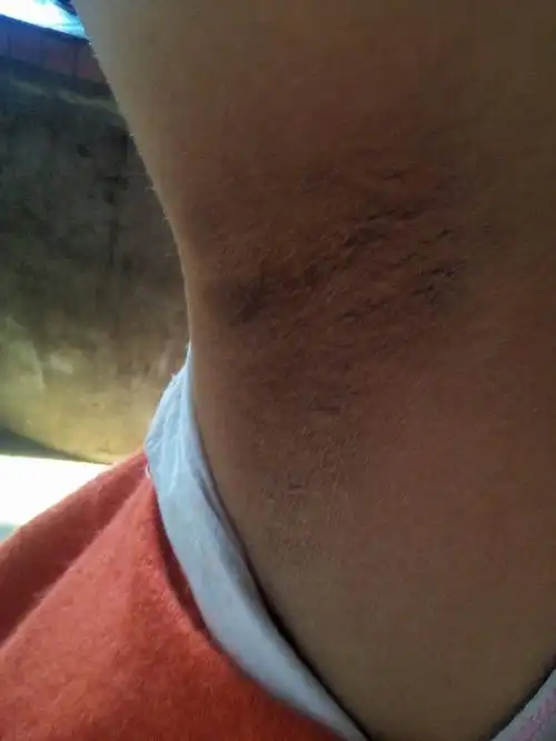 女14岁,腋下有污渍,这是癣吗?洗不掉,抠会出血.