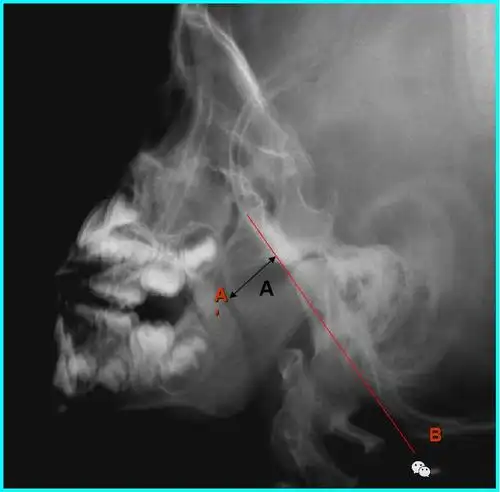 鼻咽侧位片的测量方法(二)