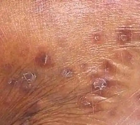 男性梅毒的前兆图片 (24)_有来医生